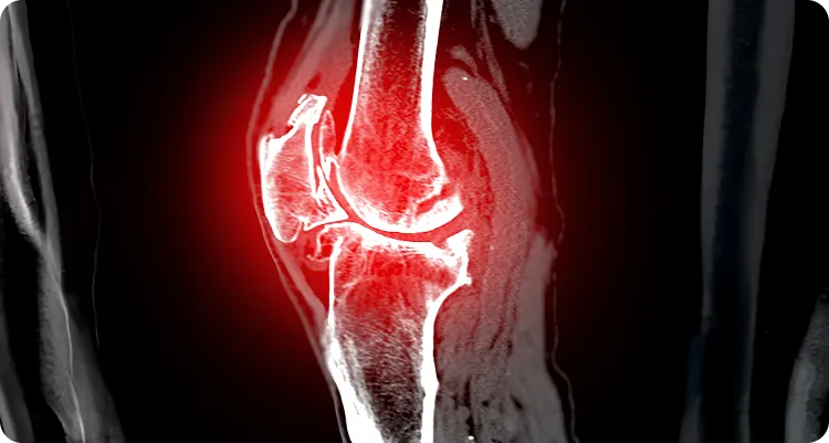 MRT Kniegelenk Arthrose