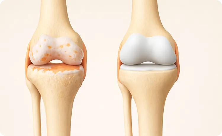 Kniegelenk Vergleich – arthrotisch und gesund